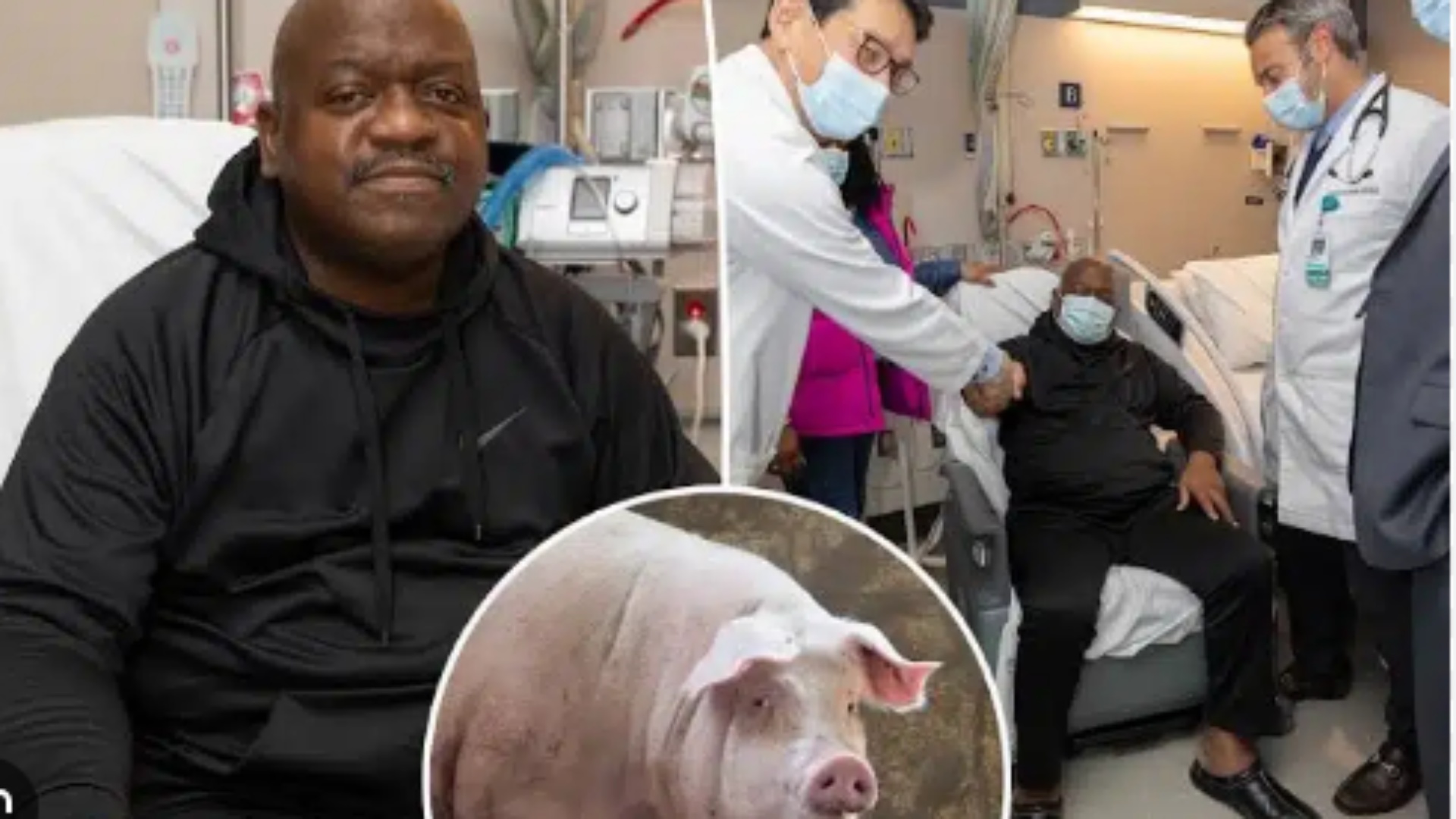 Bëri transplant veshkën e derrit, 62 vjeçari ndërron jetë 7 javë pas procedurës!